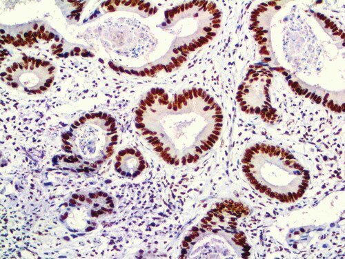 IHC of MSH2 on a Colon Carcinoma Tissue